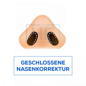Geschlossene Nasenkorrektur