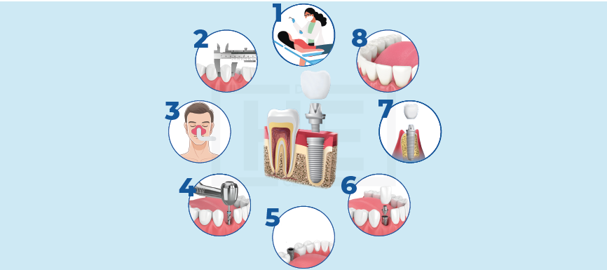 Zahnimplantat in 8 Schritten