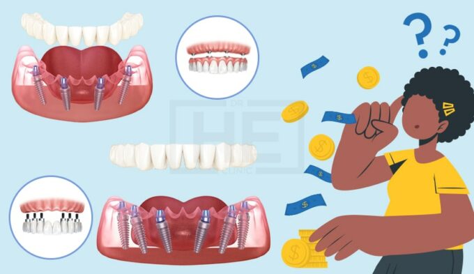 how much do 3 on 6 dental implants cost