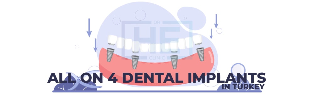 All-on-4 dental implants in Turkey