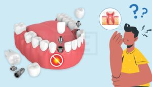 Are dental implants painful?