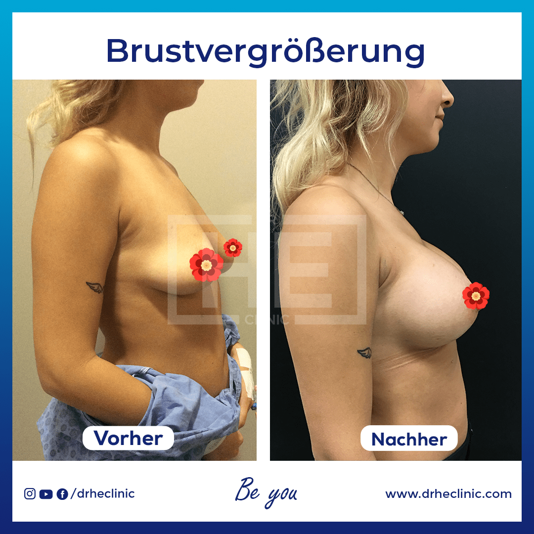 brustvergrößerung vorher nachher bilder
