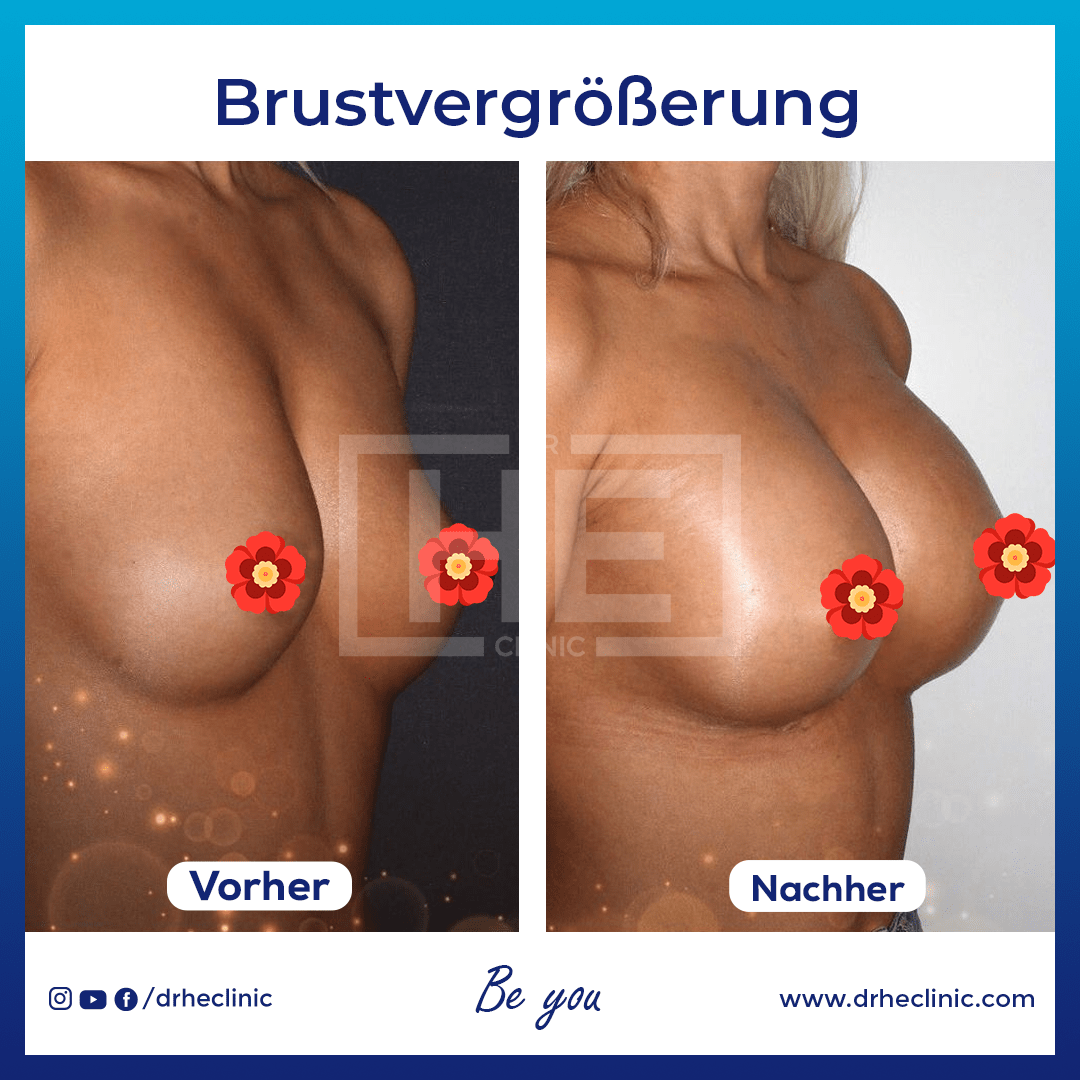 brustvergrößerung vorher nachher bilder