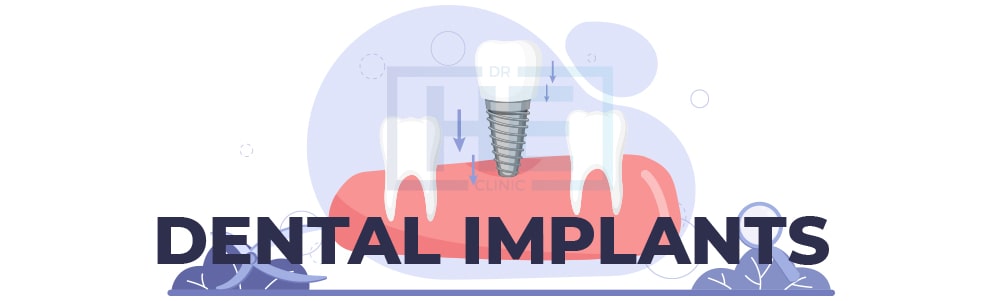  Dental Implants