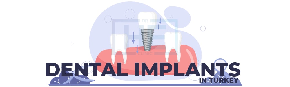 Dental implants in Turkey