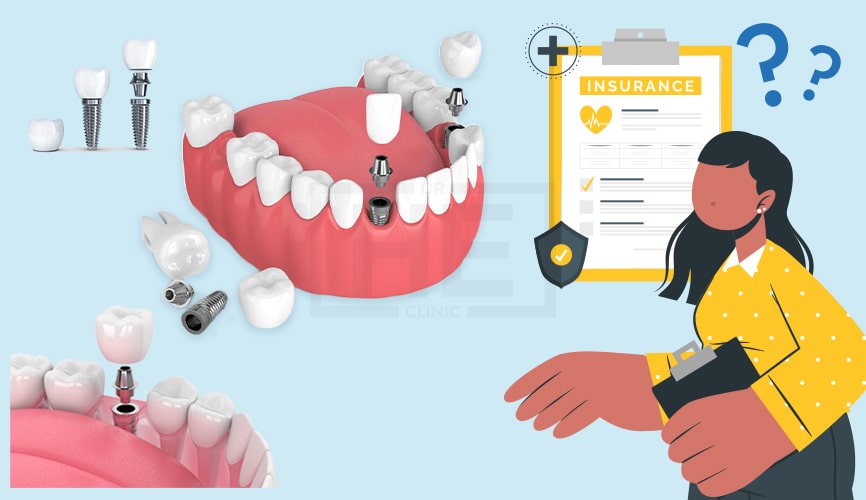 Does Insurance Cover Dental Implants?