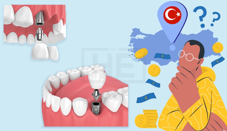How much are dental implants in Turkey