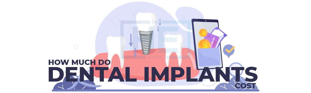 How Much Do Dental Implants Cost?