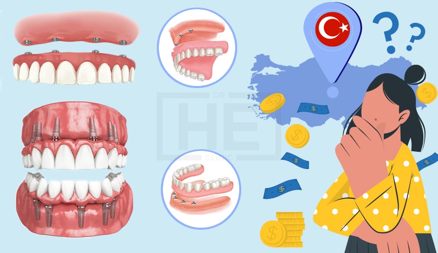 Full Mouth Dental Implants in Turkey