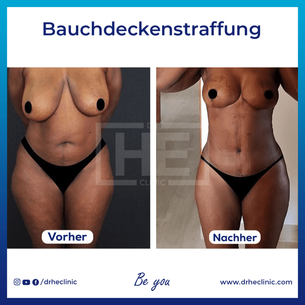 Bauchdeckenstraffung Vorher-Nachher-Bilder