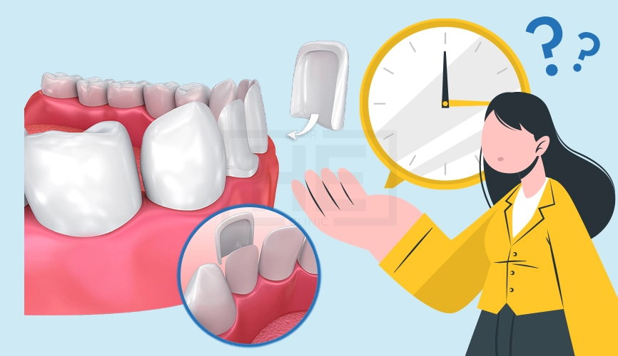 How Long Do Veneers Last?