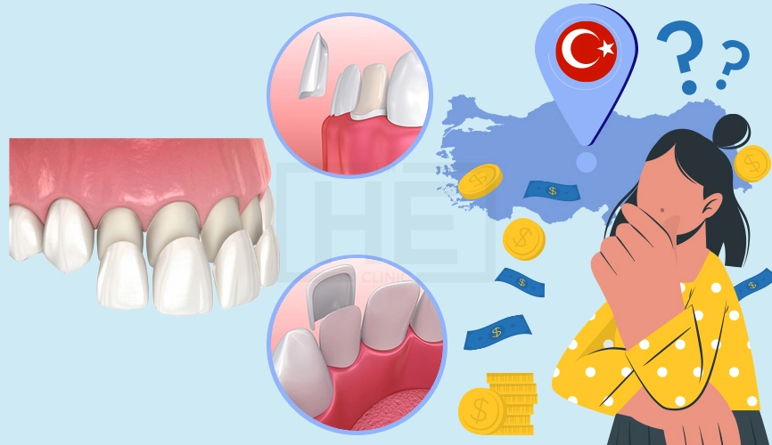 Veneers in Turkey