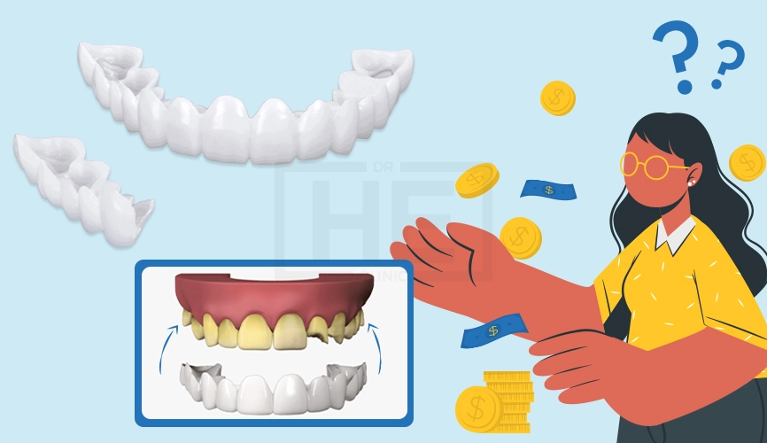 How Much Do Veneers Cost?