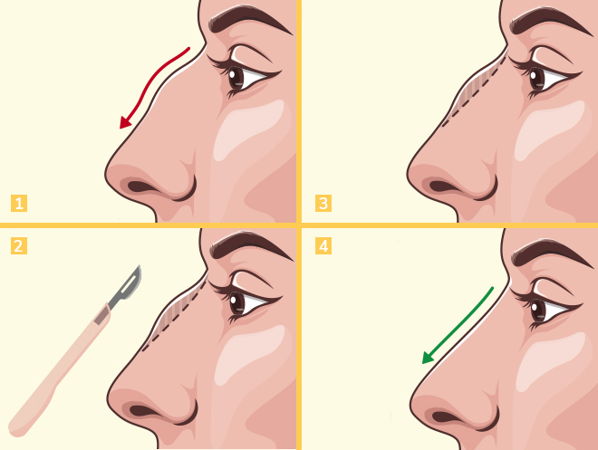 Rhinoplasty in Turkey