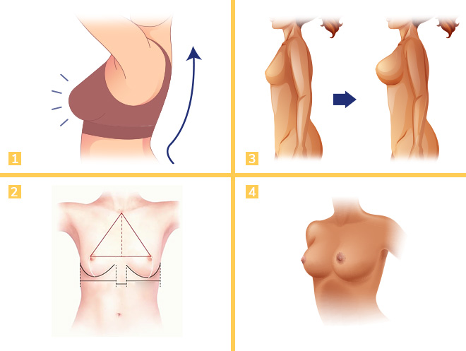 Breast Augmentation Surgery in Turkey