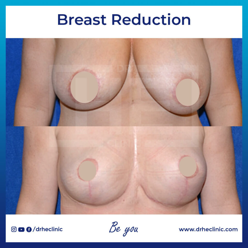Breast Reduction Surgery in Turkey