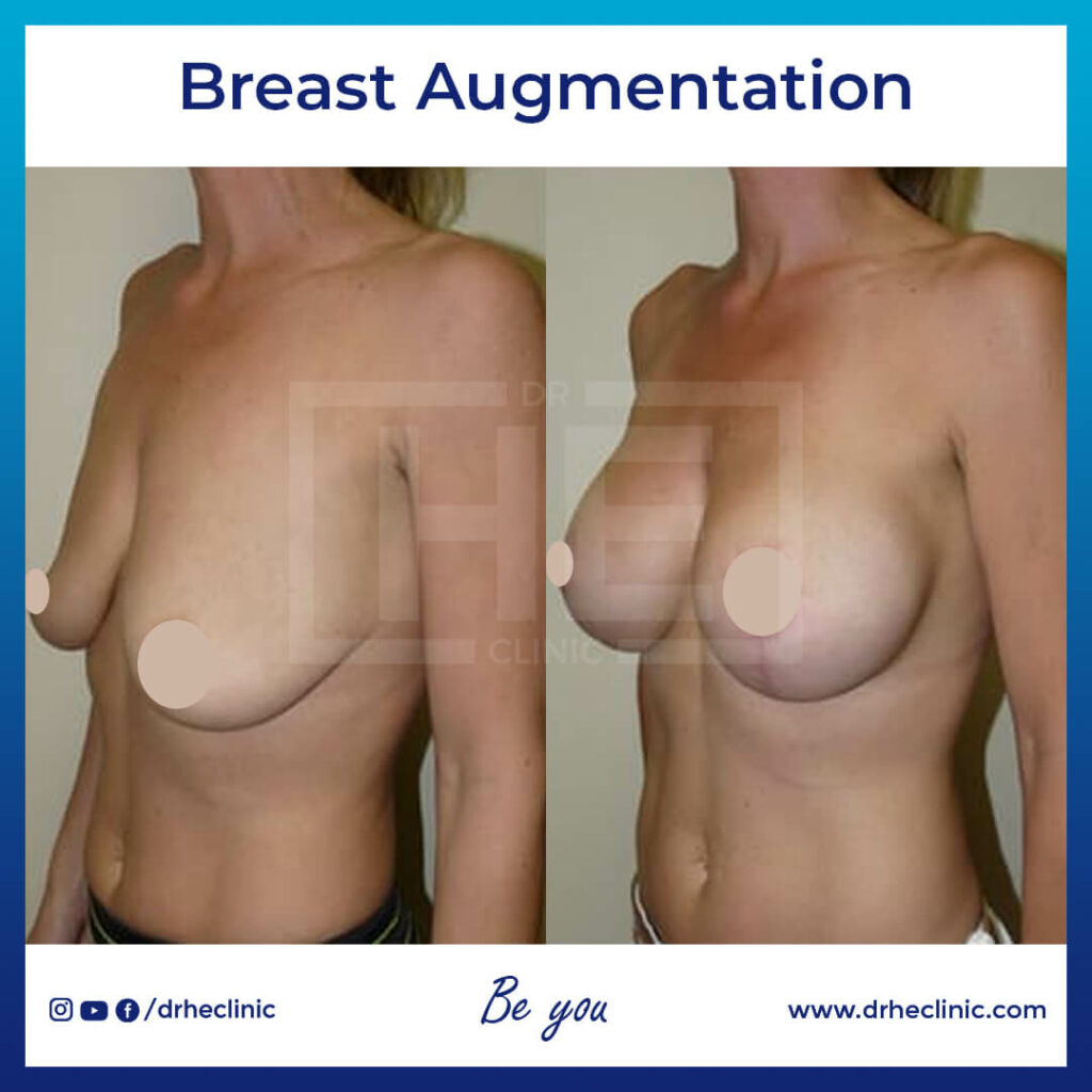 Breast Augmentation Surgery in Turkey