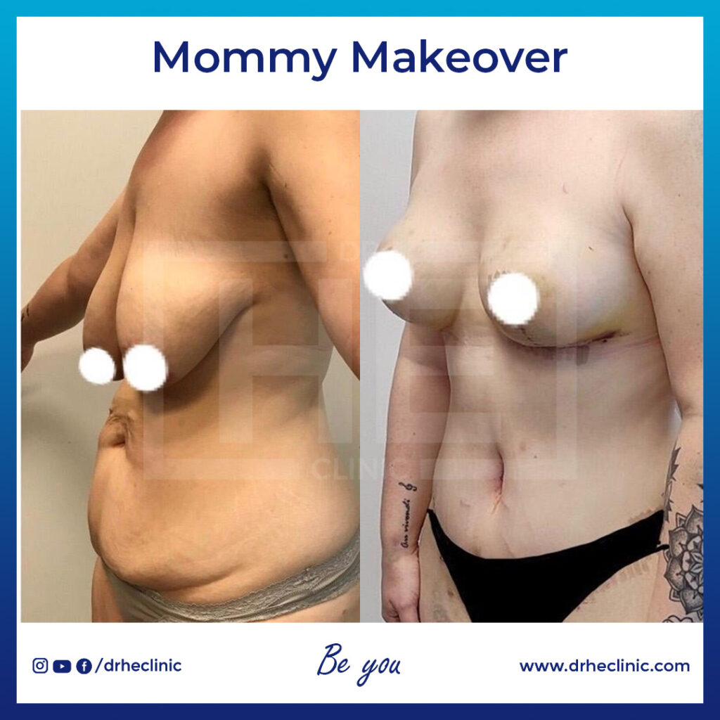 Mommy Makeover in Turkey