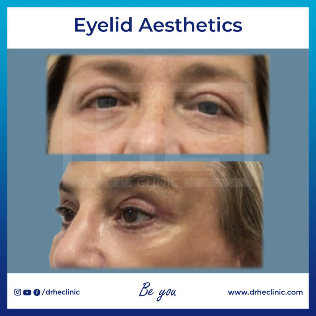 Eyelid Aesthetics in Turkey