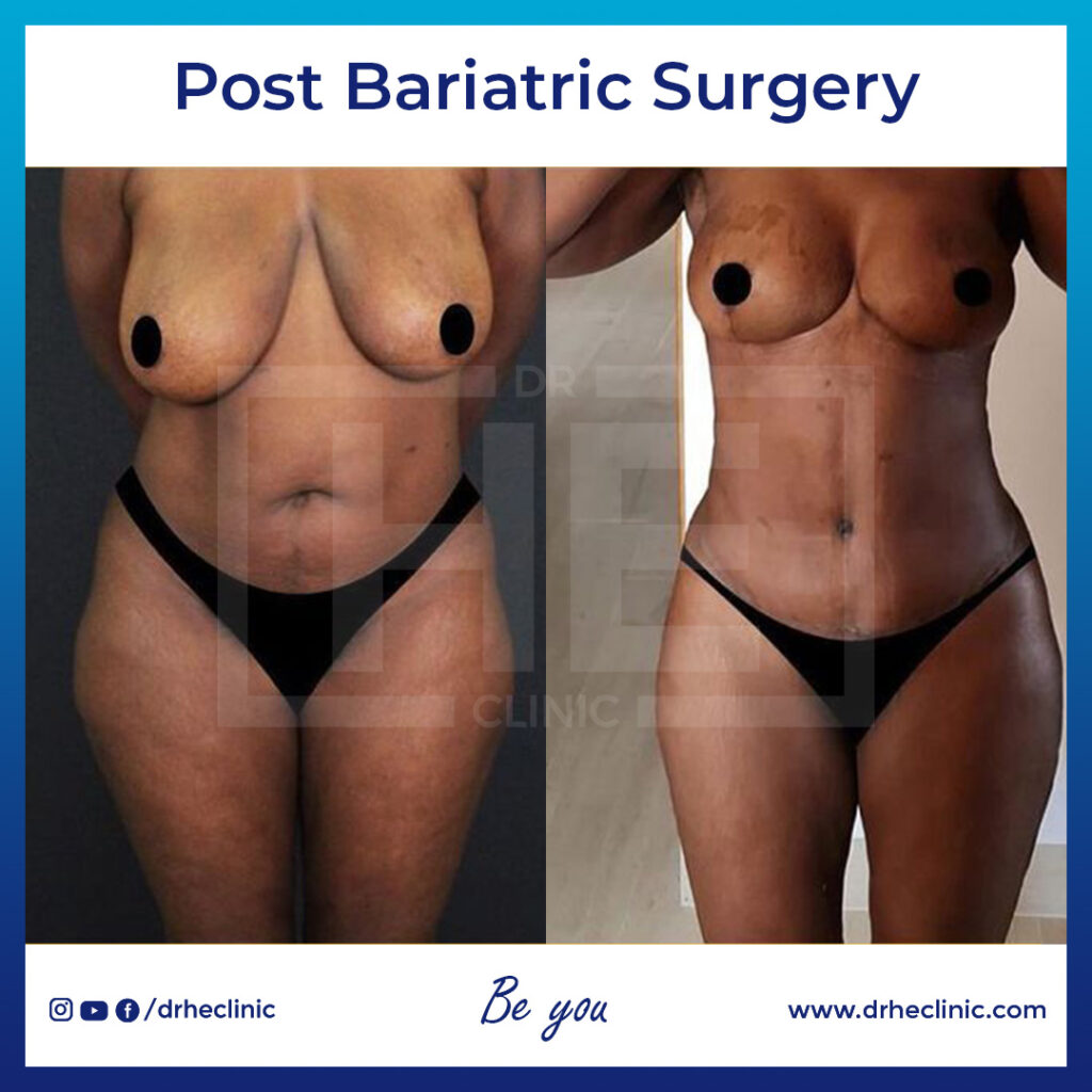 Post Bariatric Surgery in Turkey