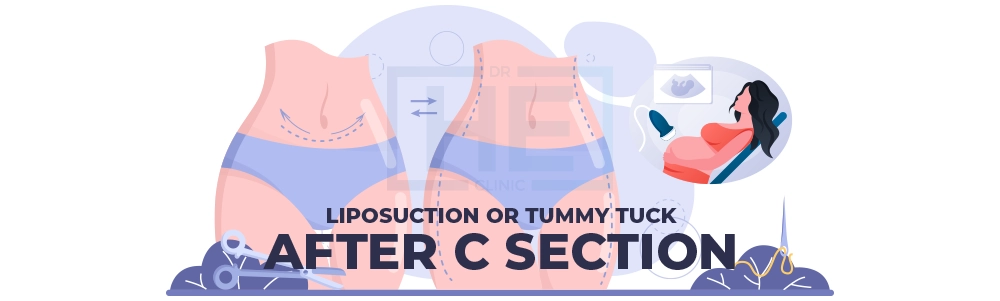 Liposuction Or Tummy Tuck After C Section