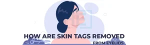 How Are Skin Tags Removed From Eyelids