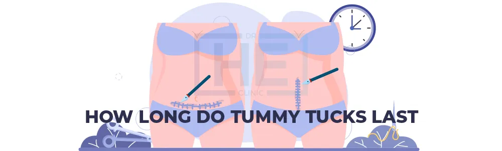 How Long Do Tummy Tucks Last?